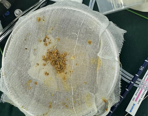 末端可弯输尿管软镜碎石术：以柔克刚，守护肾健康